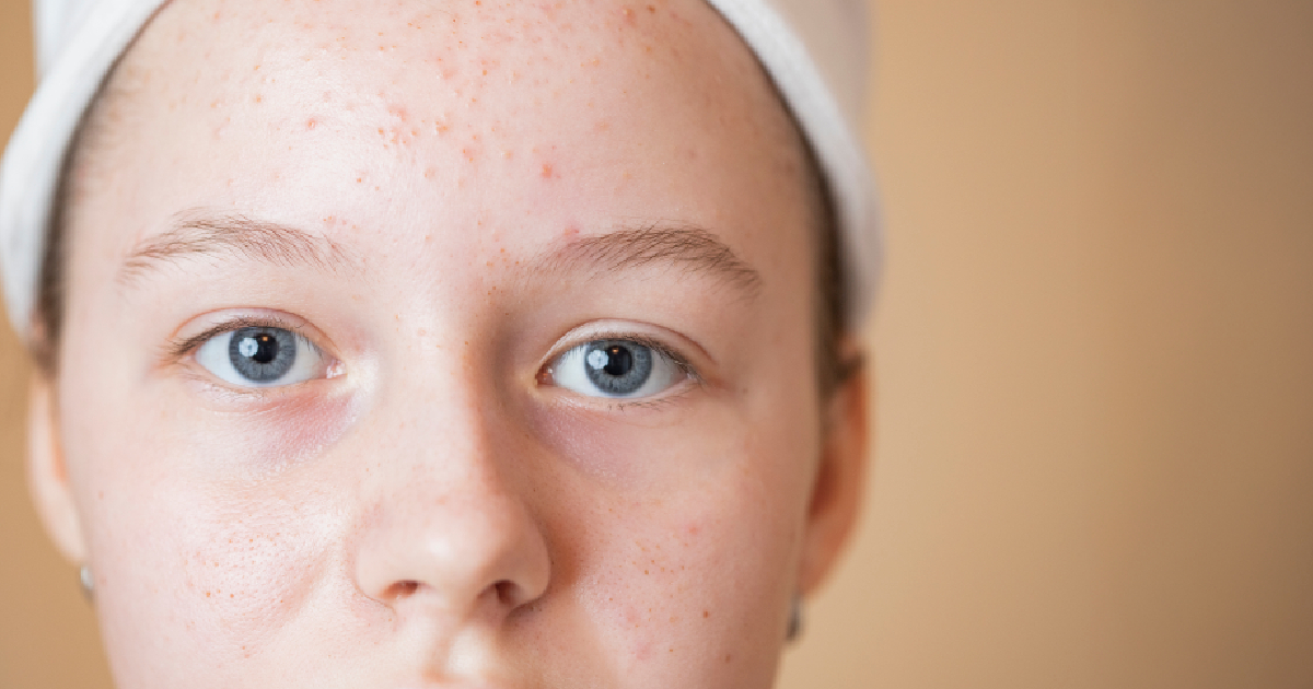 Mujer con brotes ligeros de acné
